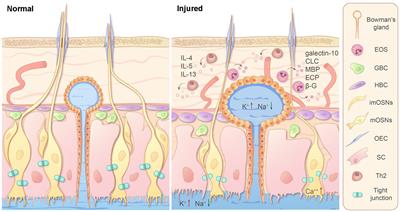 Apoptosis and turnover disruption of olfactory sensory neurons in eosinophilic chronic rhinosinusitis